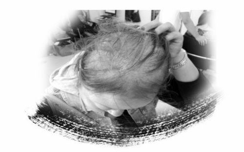 女孩理发店染发后患接触性皮炎致头发大量脱落